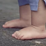 Reconstruction of Prosthetics Provided to Children